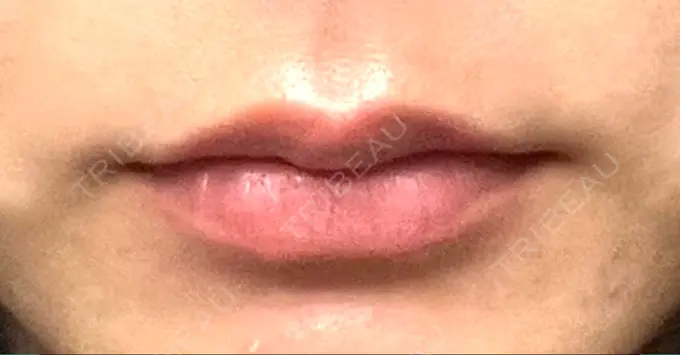 ヒアルロン酸注入（唇） 湘南美容クリニック 藤沢院 BEFORE メイン用