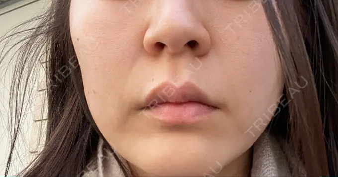 ハイフ（顔） / イオン導入 メディアージュクリニック 青山院 BEFORE メイン用