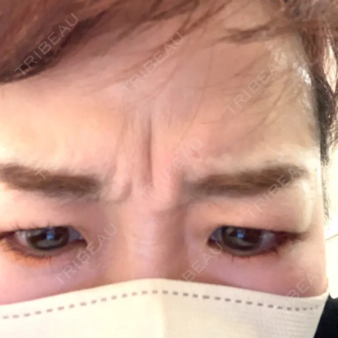 ボトックス（眉間） / その他（鼻） ルラ美容クリニック 大阪本院 BEFORE メイン用