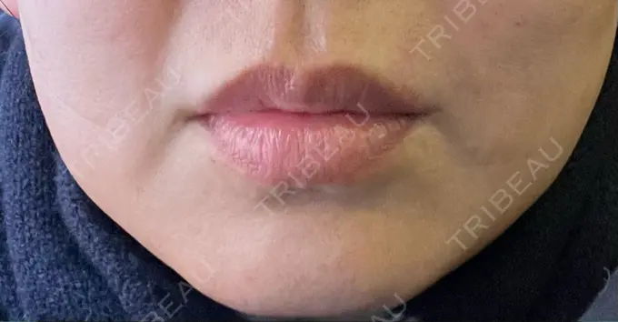 バッカルファット除去 / 脂肪吸引（顔） 湘南美容クリニック 博多院 BEFORE メイン用