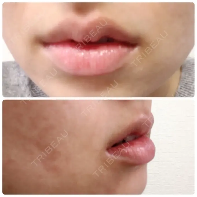 口唇縮小術 品川スキンクリニック表参道院 BEFORE メイン用