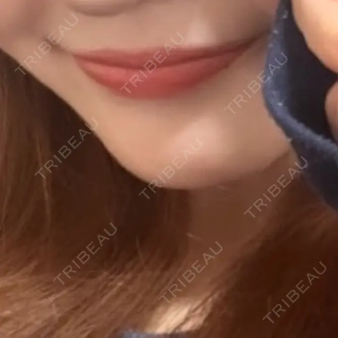 ヒアルロン酸注入（唇） TCB東京中央美容外科 草津院 BEFORE メイン用