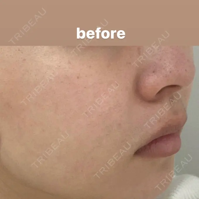 ポテンツァ 渋谷美容外科クリニック 渋谷院 BEFORE メイン用