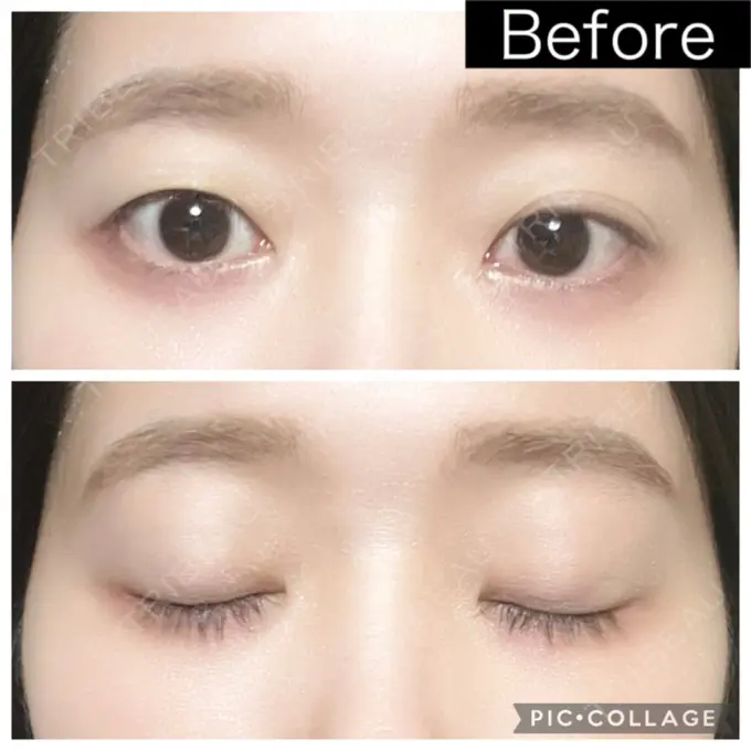 二重埋没 湘南美容クリニック 町田院 BEFORE メイン用