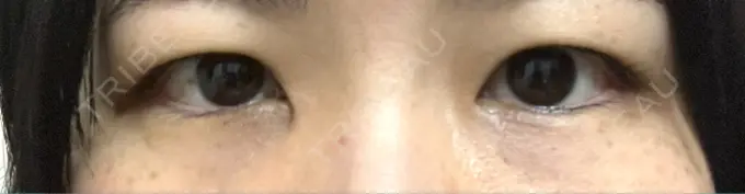 二重埋没 日本ウェルネス再生クリニック BEFORE メイン用