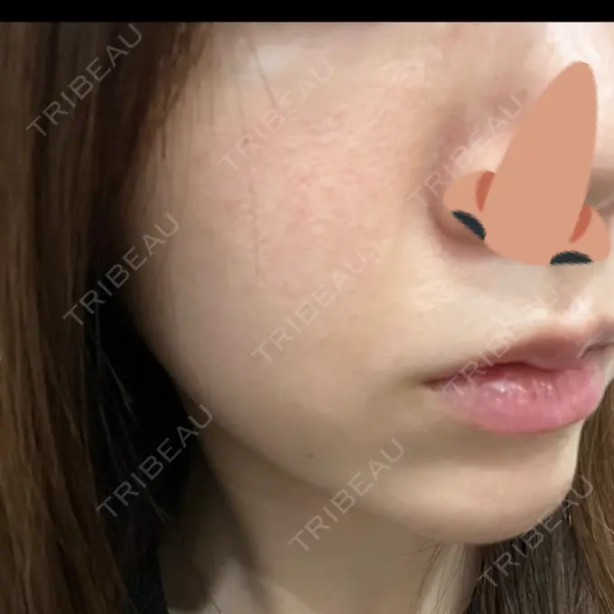 ダーマペン / ヴェルヴェットスキン 表参道メディカルクリニック 福岡天神院 BEFORE メイン用