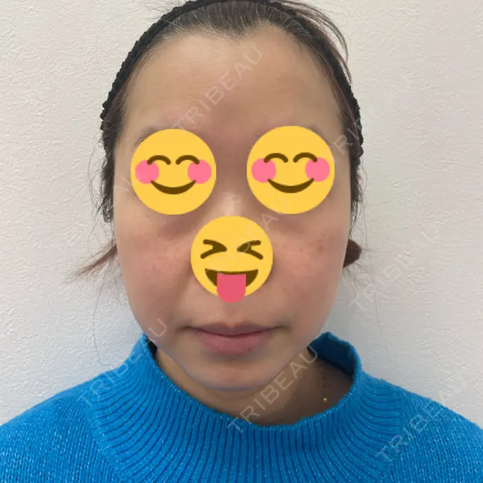 脂肪吸引（顔） / 下まぶたたるみ取り / ボトックス（エラ・小顔） / ハイフ（顔） TCB東京中央美容外科 梅田大阪駅前院 BEFORE メイン用