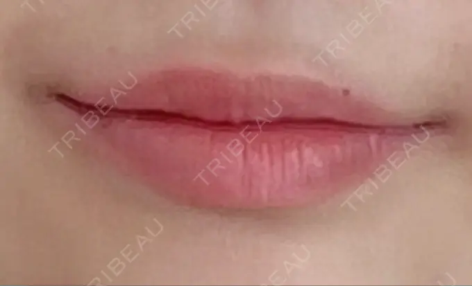 ヒアルロン酸注入（あご） / ボトックス（エラ・小顔） / ヒアルロン酸注入（唇） / ボトックス（口角） THE FIRST CLINIC 多摩センター院 BEFORE メイン用