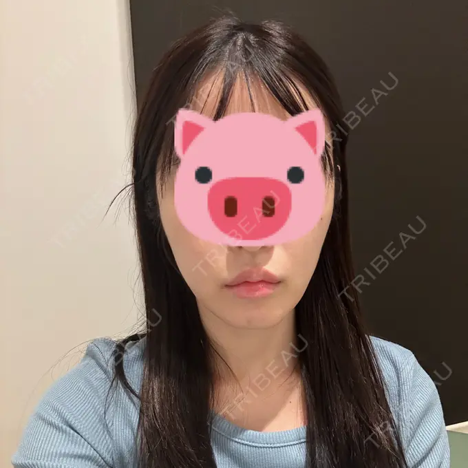 糸リフト / 脂肪吸引（顔） / ボトックス（エラ・小顔） RIVER CLINIC（リバークリニック） BEFORE メイン用