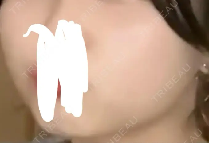 ボトックス（エラ・小顔） ルラ美容クリニック 千葉院 / ルラスキンクリニック 千葉院 BEFORE メイン用