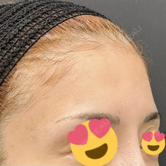 ヒアルロン酸注入（頬） シェリークリニック 新宿本院 BEFORE メイン用