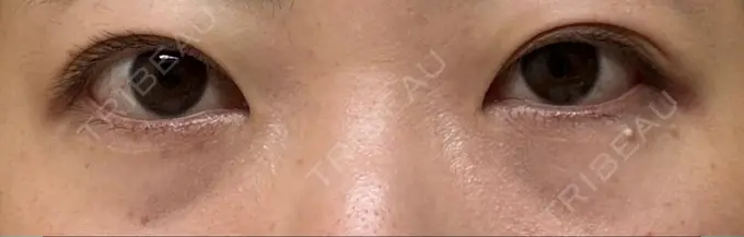 クマ治療 / 脂肪注入（目の下） アリエル美容クリニック 大宮院 BEFORE メイン用