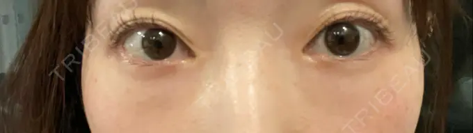 クマ治療 ジョウクリニック 大阪院 BEFORE メイン用