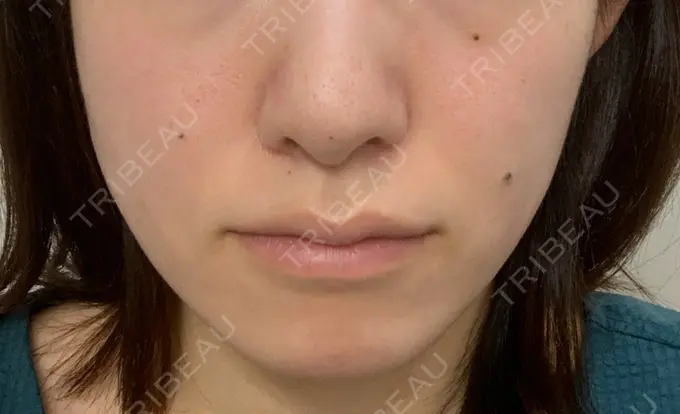 ボトックス（エラ・小顔） TCB東京中央美容外科 郡山院 BEFORE メイン用