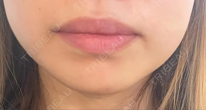 ヒアルロン酸注入（あご） / 脂肪溶解注射（顔） 麻布十番クレールデンタルクリニック BEFORE メイン用