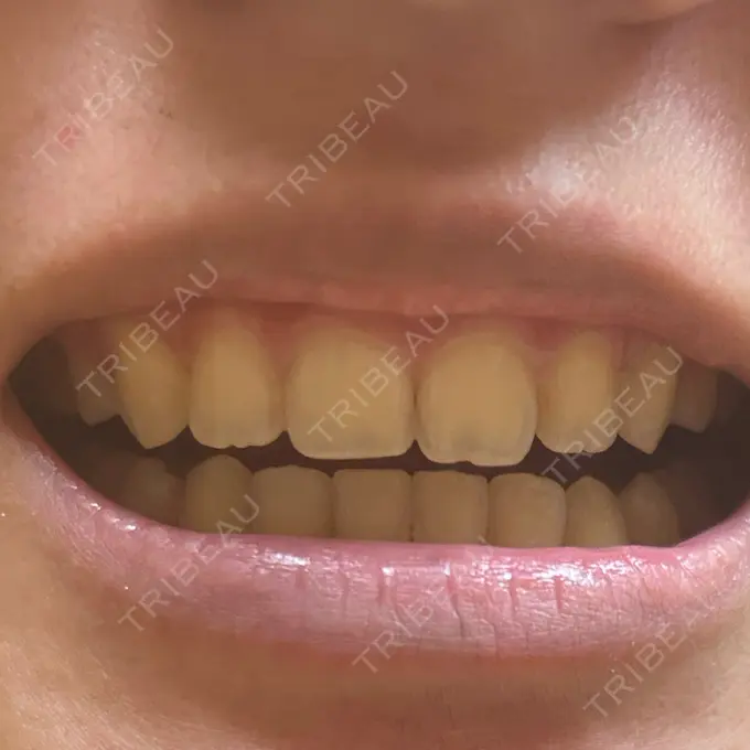 ホワイトニング オーラルビューティークリニック クラリス審美歯科・矯正歯科 BEFORE メイン用