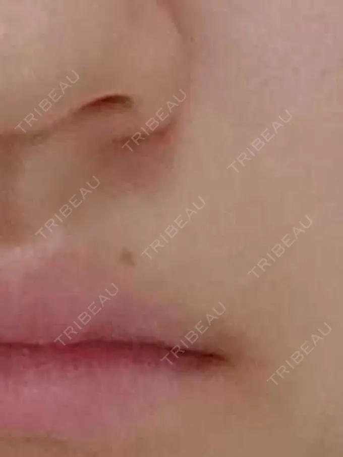 ほくろ・いぼ切除（肌） / ボトックス（エラ・小顔） 品川美容外科 渋谷院（※品川スキンクリニック提携） BEFORE メイン用