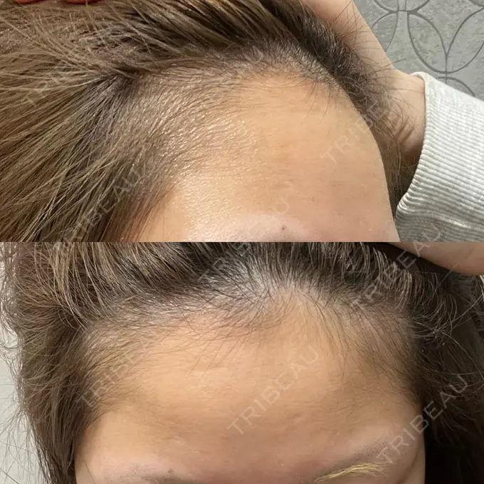 ヒアルロン酸注入（額） / ヒアルロン酸注入（こめかみ） LA CLEF CLINIC（ラクレクリニック） BEFORE メイン用