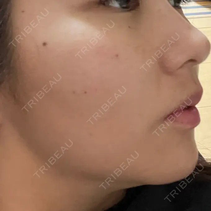 糸リフト Ginza 78 Clinic BEFORE メイン用