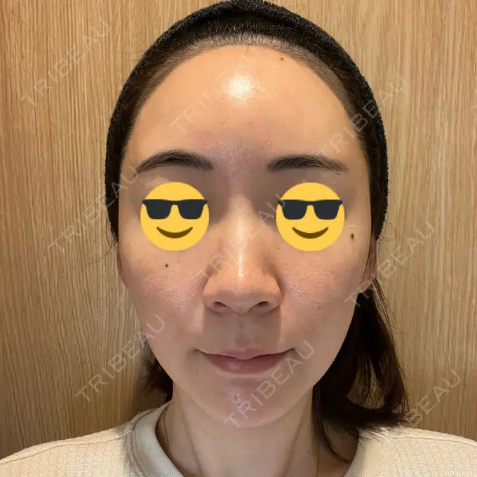 シミ取りレーザー BBC表参道院 BEFORE メイン用