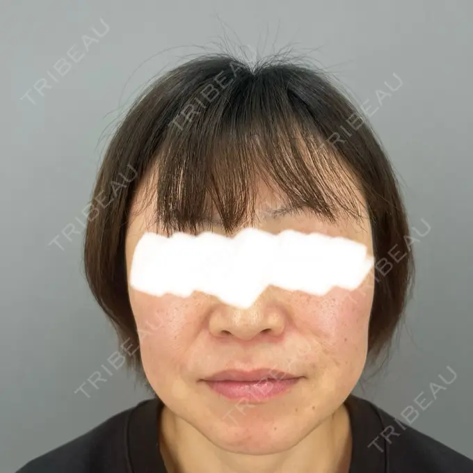 糸リフト / 脂肪吸引（顔） / 脂肪吸引注射（顔） ziz CLINIC BEFORE メイン用