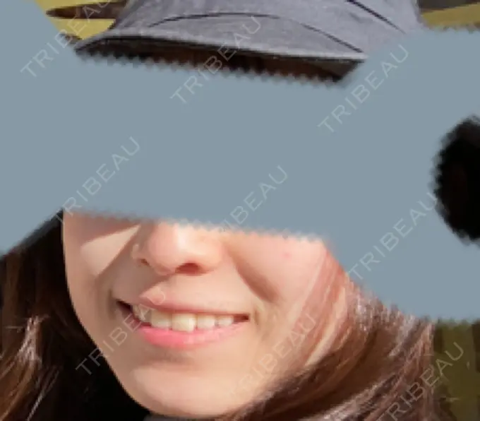 ピコレーザートーニング（美白・肝斑） SIGNATURE CLINIC 銀座 BEFORE メイン用