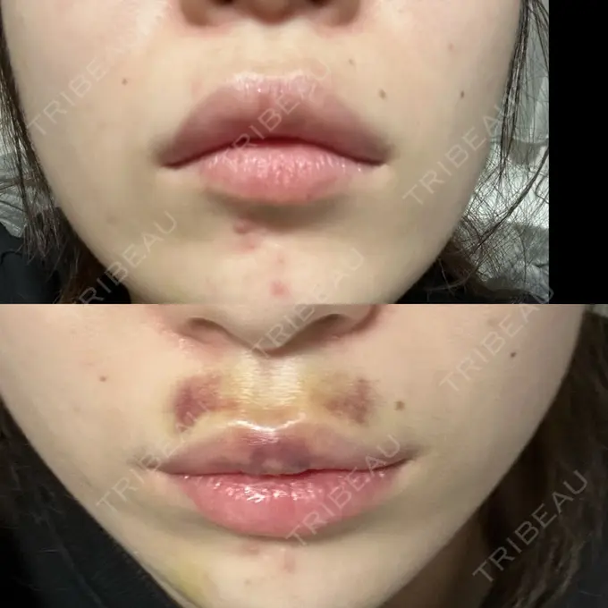 ヒアルロン酸注入（あご） / ボトックス（エラ・小顔） / ヒアルロン酸注入（唇） / ボトックス（口角） ルラ美容クリニック 広島院 BEFORE メイン用