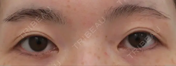 二重切開 / 上まぶたたるみ取り / 眼瞼下垂（非切開） WOM CLINIC GINZA （ワム クリニック ギンザ） BEFORE メイン用