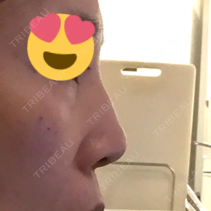 隆鼻術 / 鼻尖形成（切開） / 鼻中隔延長（切開） / 骨切幅寄せ / ワシ鼻修正・ハンプ切除 / ヒアルロン酸溶解 ミナ美容外科 BEFORE メイン用