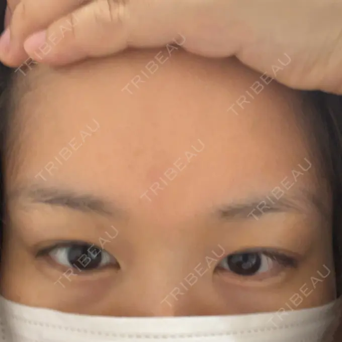 アートメイク（眉） 東京中央クリニック BEFORE メイン用