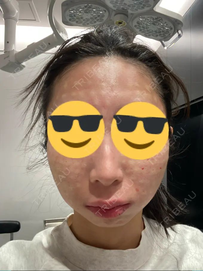 リジュラン BIANCA銀座 BEFORE メイン用