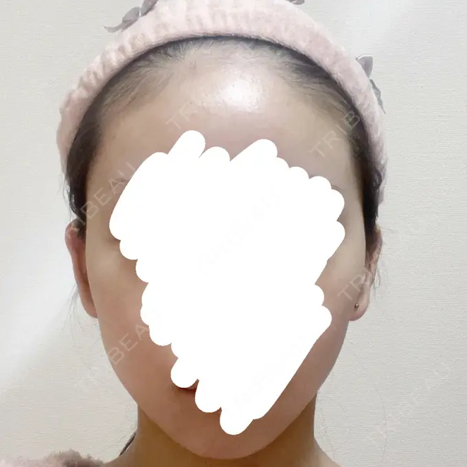 脂肪吸引（顔） Mods Clinic（モッズクリニック） 名古屋院 BEFORE メイン用