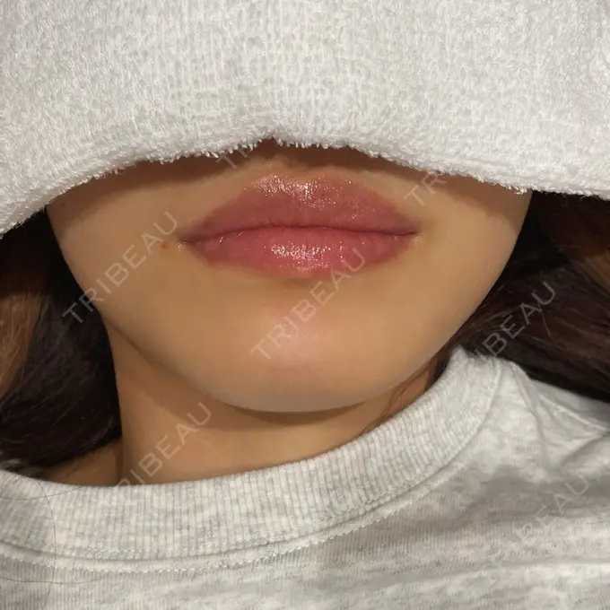 アートメイク（唇） にしまき美容スキンクリニック BEFORE メイン用