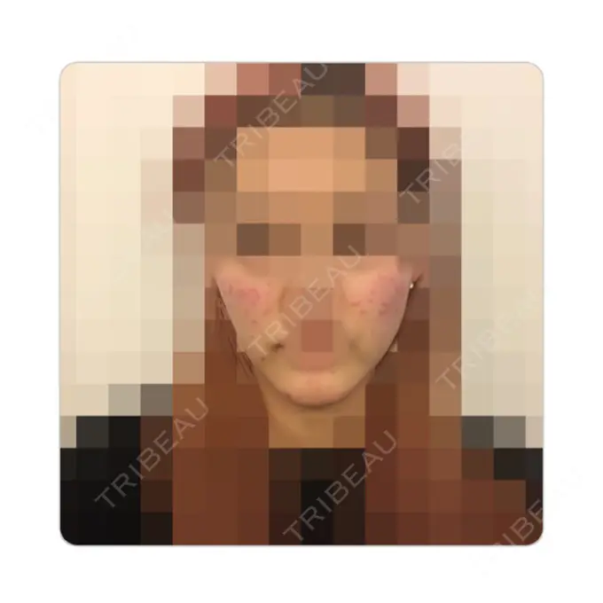 再生医療 / ニキビ治療 ニューセンス皮膚科クリニック BEFORE メイン用