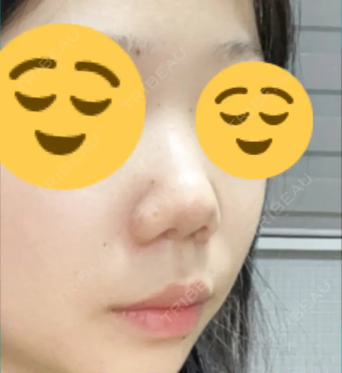 鼻尖形成（切開） / 小鼻縮小（切開） / 軟骨移植 / 鼻中隔延長（非切開） グランド整形外科 BEFORE メイン用