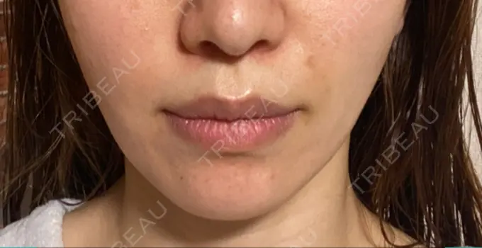 その他（肌） Rosa Beauty Clinic BEFORE メイン用