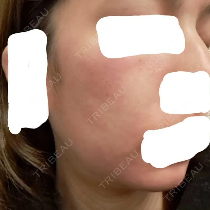 ヴェルヴェットスキン ブリリアスキンクリニック BEFORE メイン用