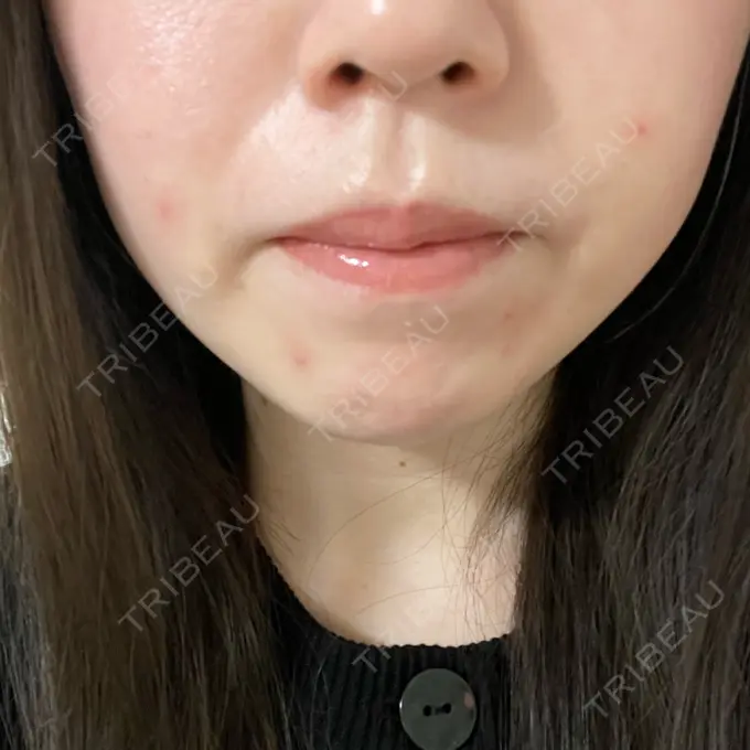 光治療（フォトフェイシャルなど） ミニマムスキンクリニック池袋 BEFORE メイン用