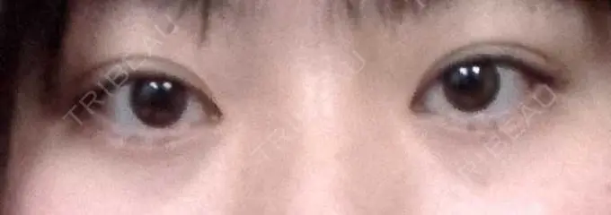 ヒアルロン酸注入（涙袋） フィラークリニック 大阪梅田院 BEFORE メイン用