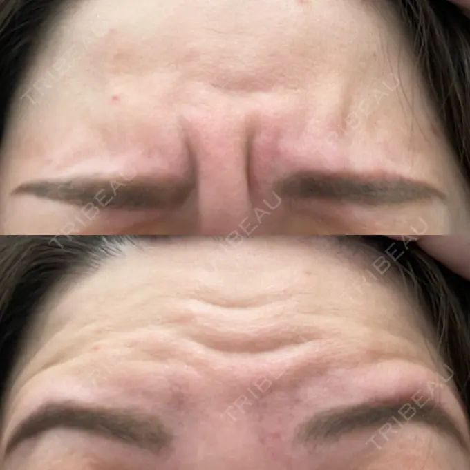 ボトックス（額） TCB東京中央美容外科 横浜駅前院 BEFORE メイン用