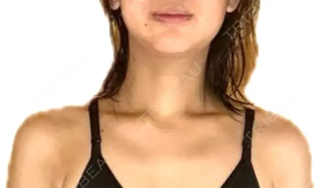 ボトックス（肩） 日本ウェルネス再生クリニック BEFORE メイン用