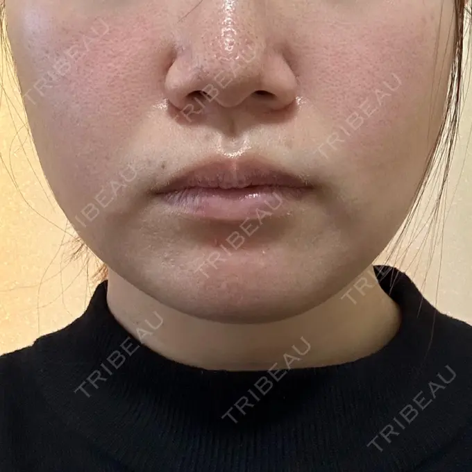 ボトックス（エラ・小顔） / ハイフ（顔） 川越TAクリニックアソシエ BEFORE メイン用