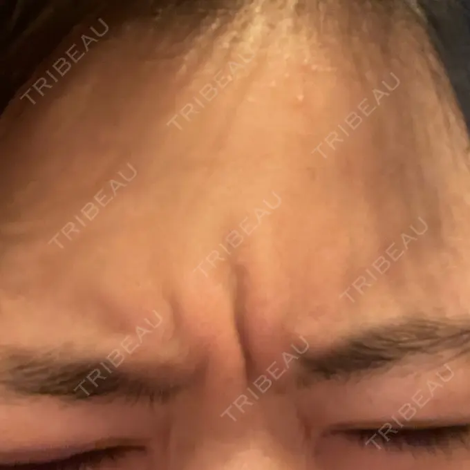 ボトックス（眉間） 湘南美容クリニック 金山院 BEFORE メイン用