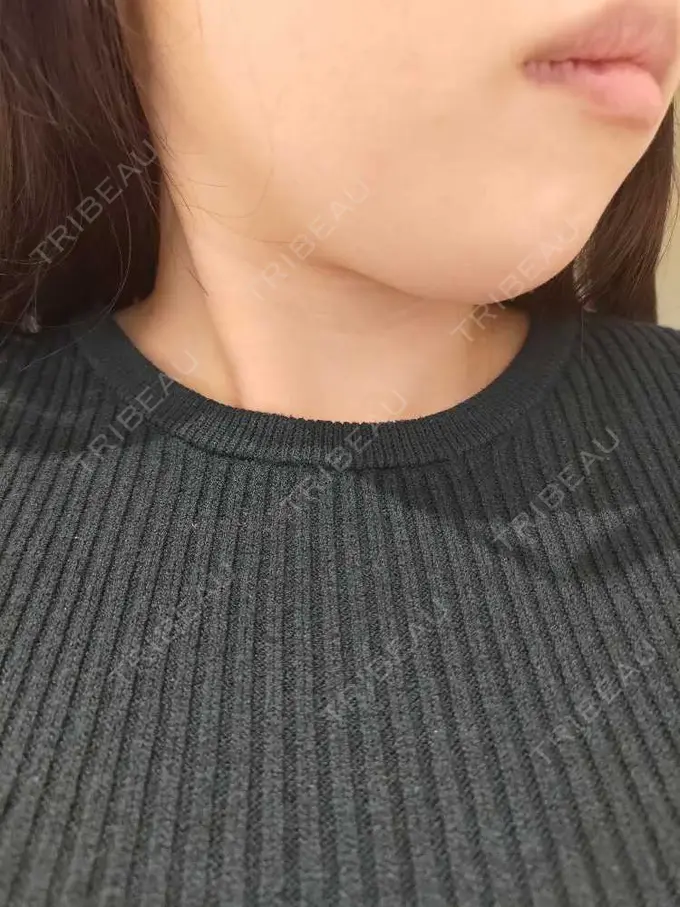 脂肪溶解注射（顔） 表参道ウィズ・クリニック BEFORE メイン用