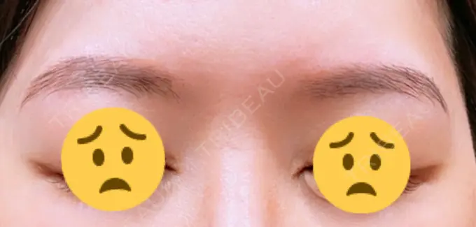 アートメイク（眉） MYCLINIC 西新宿 BEFORE メイン用