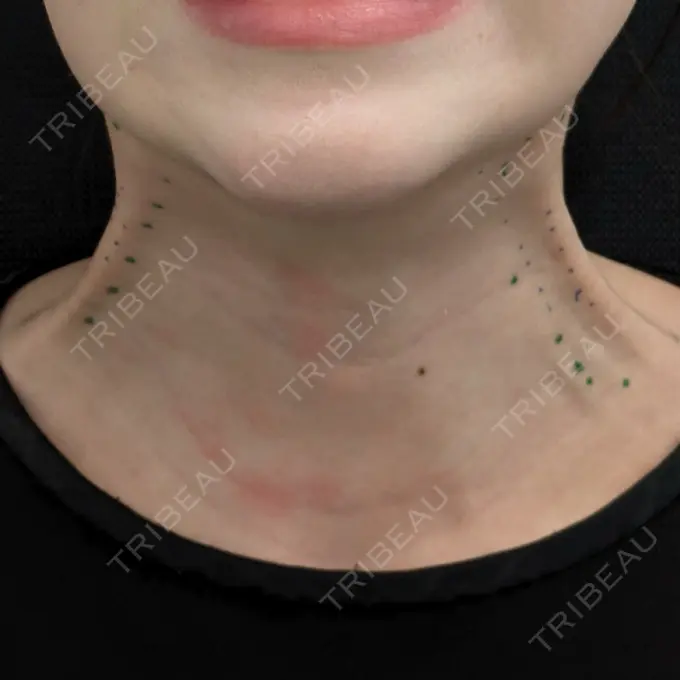 ガミースマイル手術 / ボトックス（エラ・小顔） / ボトックス（首） 東京シンデレラ美容外科 大宮院 BEFORE メイン用