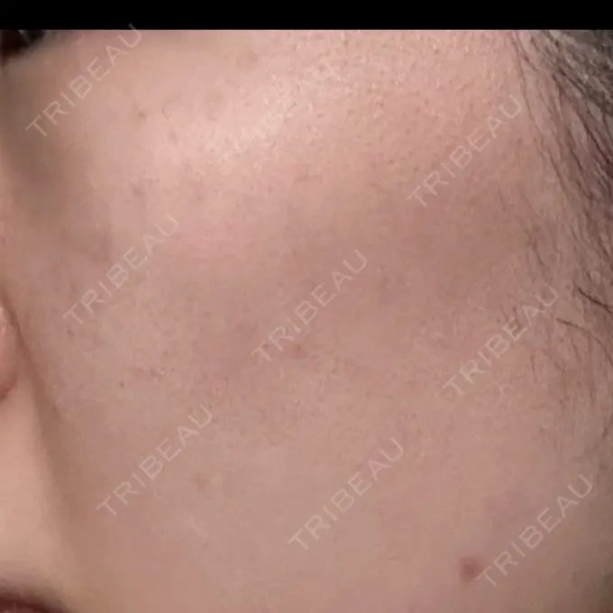 エレクトロポレーション / ピーリング（ハリ・ツヤ） / ルメッカ Otus Clinic 【オータスクリニック】 BEFORE メイン用