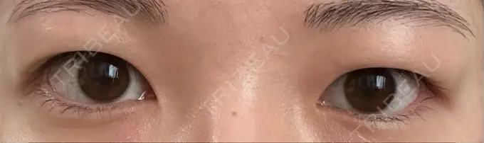 二重埋没 湘南美容クリニック 京都院 BEFORE メイン用