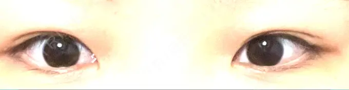 目頭切開 もとび美容外科クリニック 新宿院 BEFORE メイン用