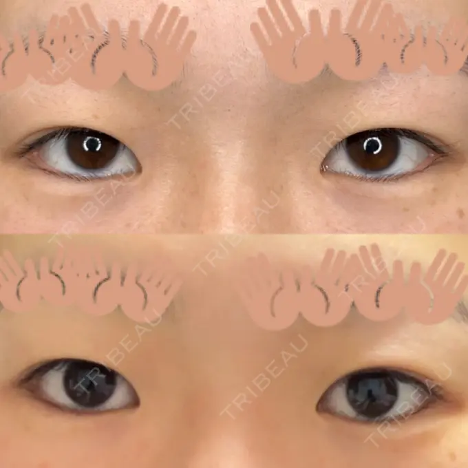 二重埋没 / ヒアルロン酸注入（涙袋） 藤・ナチュレ美容クリニック 銀座院 BEFORE メイン用